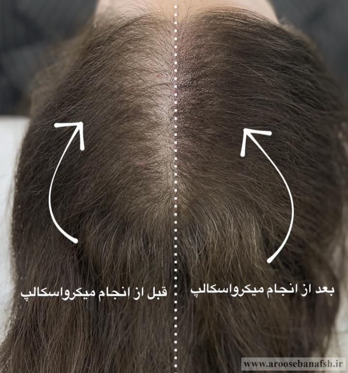 میکرو اسکالپ سر